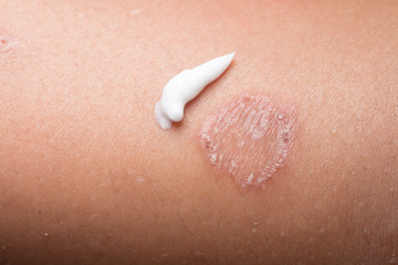 Ring Worm infection, Dermatophytosis