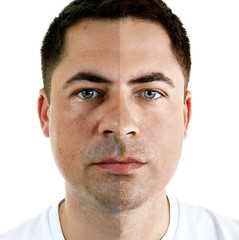 Obraz premium Man face before and after cosmetic procedure. Plastic surgery concept.