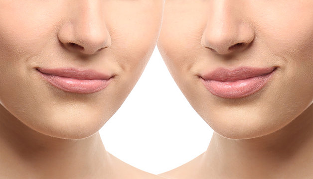 Woman lips before and after cosmetic procedure. Plastic surgery concept.