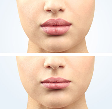 Woman lipc before and after cosmetic procedure. Plastic surgery concept.