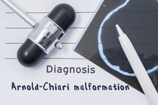 Diagnosis Arnold Chiari malformation. Written medical report, which indicated neurological diagnosis Arnold Chiari malformation, surrounded by MRI of brain and reflex hammer on desk in doctor office