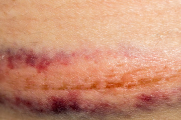 Bruise on Skin