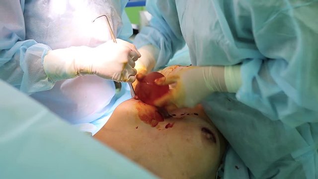 Insert the implant in the breast