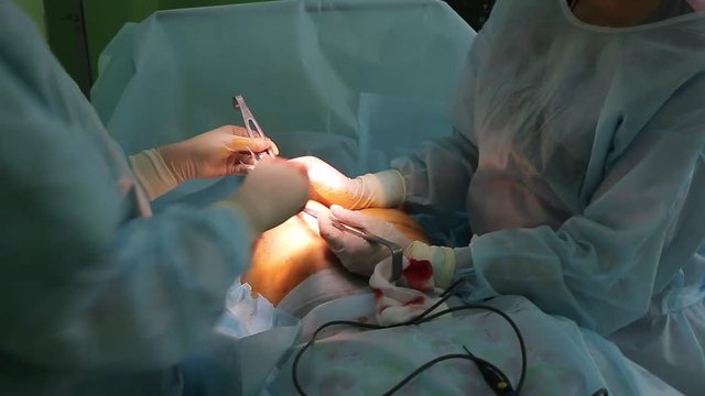 Insert the implant in the breast