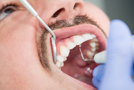 Removing dental plaque closeup