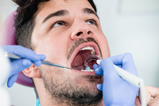 Professional teeth cleaning, calculus removal