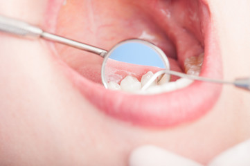 Close-up of dental inspection with orthodontist mirror