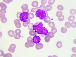 Leukemia cells in peripheral blood smear, Wright stain