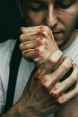 Hombre joven con lesiones y heridas en las manos 