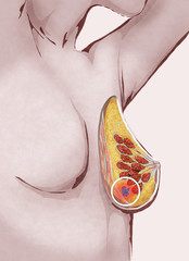 Illustrazione di seno di donna con cancro