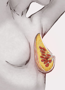 Illustrazione di seno di donna con cancro