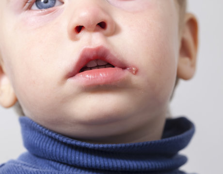 Herpes On The Mouth Of The Child