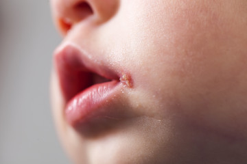 herpes on the mouth of the child - obrazy, fototapety, plakaty