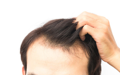 Fototapeta premium Closeup young man serious hair loss problem for hair loss concept
