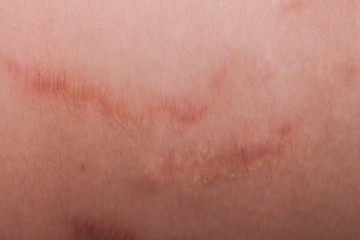 Closeup on stretch marks or cellulite on waist belly - obrazy, fototapety, plakaty