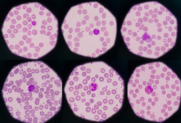Mix shape white blood cells, concept funny wbc. blood smear is often used as a follow-up test to abnormal results on a complete blood count (CBC) to evaluate the different types of blood cells.