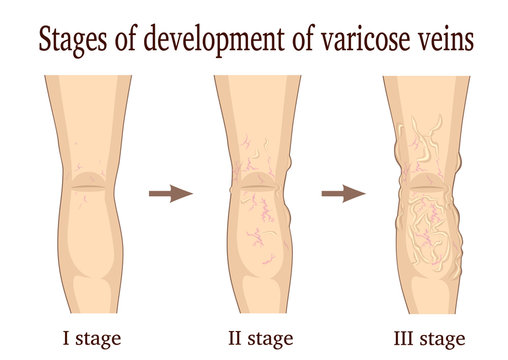 Three Stages Of The Development Of Varicose Veins Isolated On White Background