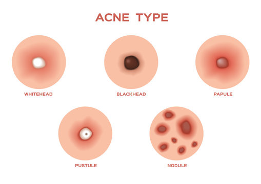 Types of Acne and Pimples, stages of development, vector illustration