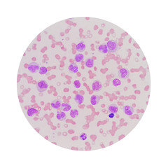 Microscopic view of a blood smear from leukemia patient showing abnormal white blood cells