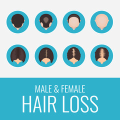 Male and female pattern hair loss set. Stages of baldness in men and women. Alopecia infographic medical design template. Hair loss clinic concept design. Vector illustration.