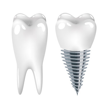 Dental implant dentistry