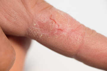 Fissur Mittelfinger links bei extrem trockener Haut im Herbst