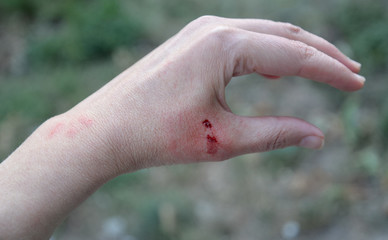 Monkey bite on the hand. Paired wounds from the animal’s upper fangs. Local inflammation around...