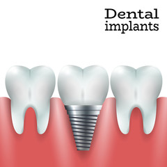 Teeth Family with Dental Implant in Healthy Gum.Dental Implant Logo Surgery Dentistry Vector Illustration. Medical Conception Tutorial for Tooth Clinic.Implant Crown and Abudment for Dental Clinic