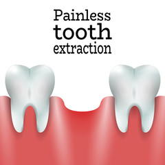 Teeth Family with Exctracted Tooth in Healthy Gum.Dental Pain free Tooth Extraction Surgery Dentistry Vector Illustration.Medical Conception Tutorial for Tooth Clinic.Oral Surgery for Dental Clinic