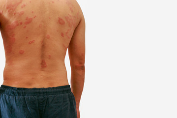 Around Back view of man with dermatitis problem of rash ,Allergy