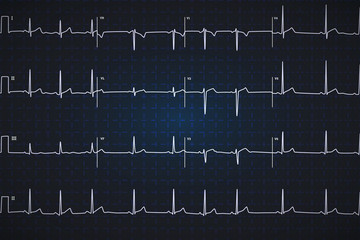 Typical human electrocardiogram, white graph on dark blue background