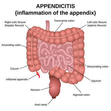 inflammation of the appendix