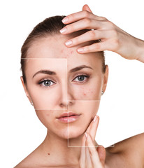 Woman with problem skin on her face