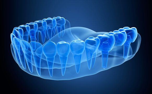 X-ray view of denture with implant.  Xray view. Medically accurate 3D illustration