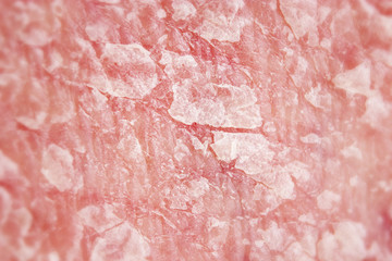 Psoriasis, psoriatic skin disease is red, itchy, and scaly, macro with narrow focus