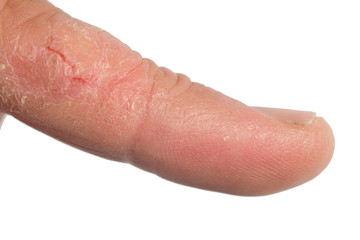 Finger, trockene Haut, Fissur