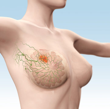 Breast cancer with lymphatics, artwork