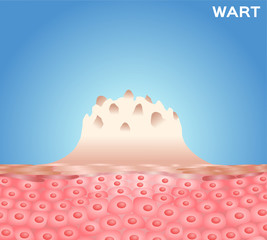 Wart on a person's hand close up , wart vector - obrazy, fototapety, plakaty