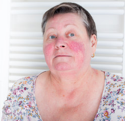 Rosacea, facial skin disorder, portrait of unhappy elderly woman