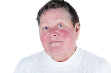 Obraz premium Rosacea, facial skin disorder, portrait of unhappy elderly woman