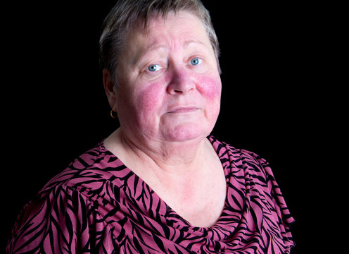 Unhappy, depressed senior woman with rosacea skin desease, studi