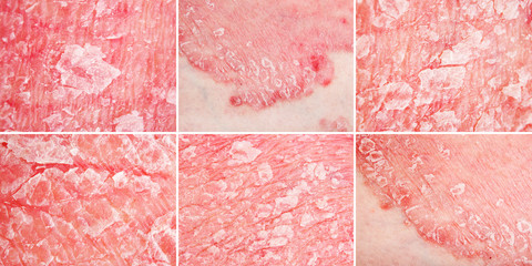 Psoriasis, psoriatic skin disease details, macro, narrow focus