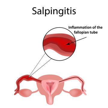 Salpingitis. Inflammation of the fallopian tube. Infographics. Vector illustration on isolated background