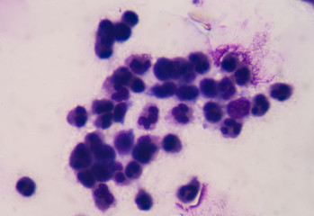 Cancer Cell in human showing abnormal cells.