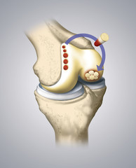 A method of cartilage transplantation in the knee - obrazy, fototapety, plakaty