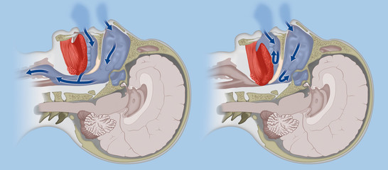 A cross section of a human head, comparing normal breathing with sleep apnoea 
