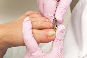 Doctor Podiatry removes calluses, corns and treats ingrown nail. Hardware manicure. Concept body...