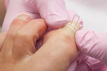 Doctor Podiatry removes calluses, corns and treats ingrown nail. Hardware manicure. Concept body care.
- 123969262