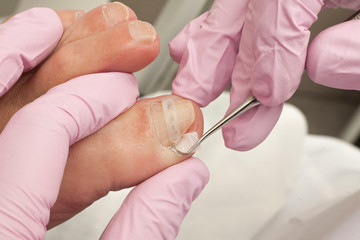 Doctor Podiatry removes calluses, corns and treats ingrown nail. Hardware manicure. Concept body care.
- 123969400