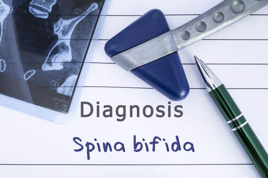 Diagnosis spina bifida. Medical health history written with diagnosis of spina bifida, MRI image sacral spine and neurological hammer. Medical concept for Neurology, Neuroscience 